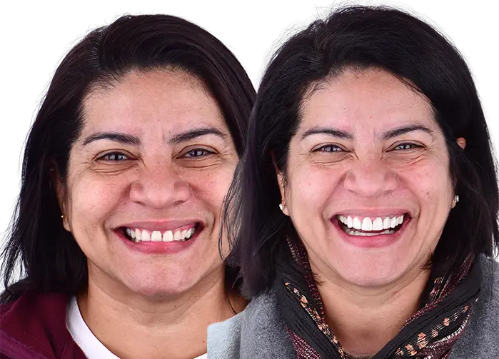Lifestyle Smiles after and before